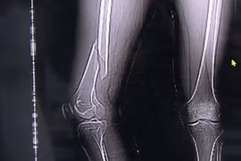 Tập yoga quá độ, thanh niên suýt liệt luôn chân