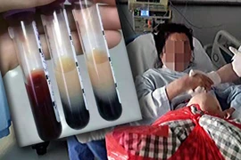 Ăn 10 đĩa thịt, bệnh nhân gây sốc vì máu chuyển màu trà sữa