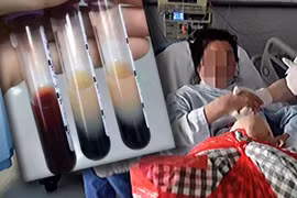 Ăn 10 đĩa thịt, bệnh nhân gây sốc vì máu chuyển màu trà sữa