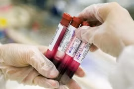 Xét nghiệm máu, biết được 8 loại ung thư 