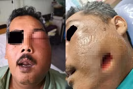 Đau răng bôi dầu máy, người đàn ông gặp chuyện hãi hùng