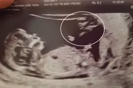 Mẹ trẻ thấy bóng lạ trong ảnh siêu âm thai, bất ngờ kỳ diệu...