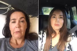 Tiêm botox để trẻ mãi không già, ai ngờ bị bại liệt vĩnh viễn