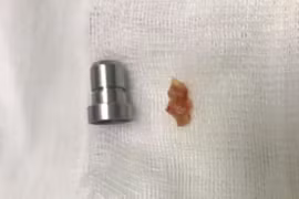 2 người phụ nữ suýt "mất Tết" vì hóc dị vật đường thở nguy hiểm