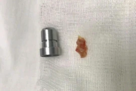 2 người phụ nữ suýt "mất Tết" vì hóc dị vật đường thở nguy hiểm