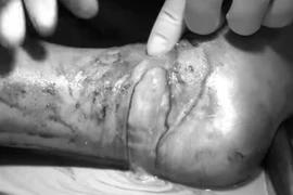 Đắp thuốc lá chữa bong gân, bé trai suýt mất chân