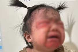 Bé 18 tháng tuổi mắc hội chứng bong vảy da do tụ cầu