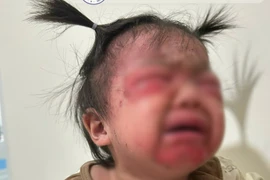 Bé 18 tháng tuổi mắc hội chứng bong vảy da do tụ cầu