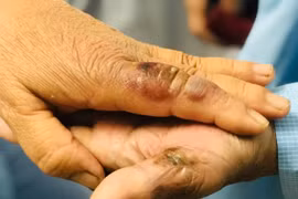 Chủ quan khi bị chuột cắn, hai vợ chồng nhập viện cấp cứu