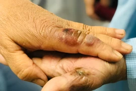 Chủ quan khi bị chuột cắn, hai vợ chồng nhập viện cấp cứu