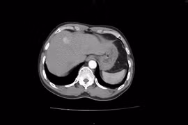 Bất ngờ phát hiện u gan sau khi đi khám sức khỏe