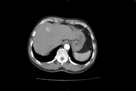 Bất ngờ phát hiện u gan sau khi đi khám sức khỏe