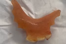 Vô tình nuốt răng giả khi ăn, dị vật thực quản nguy hiểm sao?