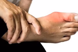 Nam sinh 17 tuổi mắc bệnh gout