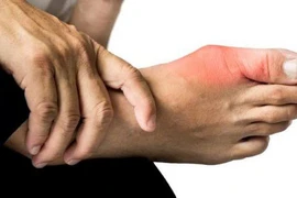 Nam sinh 17 tuổi mắc bệnh gout
