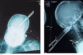 Bị dao đâm xuyên đầu vẫn lái xe máy đi báo công an