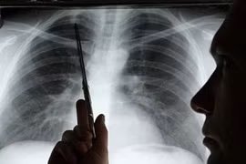 Kéo dài thời gian sống cho bệnh nhân ung thư phổi