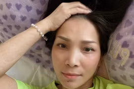 Nhan sắc ca sĩ Hồng Ngọc thế nào sau 2 tháng bị bỏng?