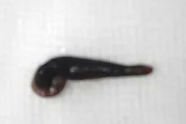 Bé 2 tuổi tắm suối, bị vắt chui vào mũi “làm tổ” 