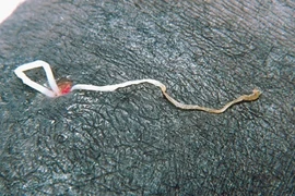 Kinh hãi cảnh giun ký sinh bị kéo ra khỏi chân người