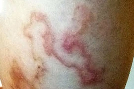 Kinh dị loài giun lươn ký sinh bò dưới da người