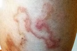 Kinh dị loài giun lươn ký sinh bò dưới da người