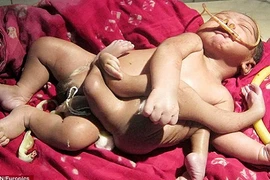 Em bé 4 tay, 4 chân gây náo loạn thành phố