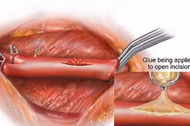 Phát minh keo hàn gắn trái tim độc đáo
