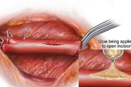 Phát minh keo hàn gắn trái tim độc đáo