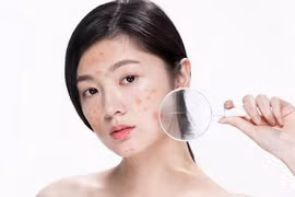 Những sai lầm trong chăm sóc da khiến càng chăm càng nhiều mụn