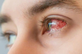 Thấy mắt mờ... đi khám phát hiện mắc bệnh giang mai