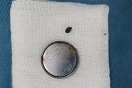 Bé gái 4 tuổi loét thực quản vì... nuốt phải pin đồng hồ