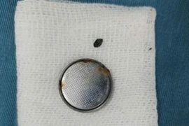 Bé gái 4 tuổi loét thực quản vì... nuốt phải pin đồng hồ