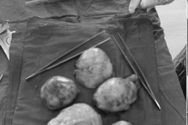 Kinh nguyệt không đều, đi khám bất ngờ phát hiện đa u xơ tử cung