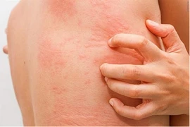 Tự nhiên bị ngứa khắp người không rõ nguyên nhân, phải làm sao?