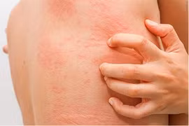 Tự nhiên bị ngứa khắp người không rõ nguyên nhân, phải làm sao?