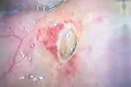 Đau bụng, buồn nôn, đi khám phát hiện thủng tạng rỗng do viêm loét dạ dày