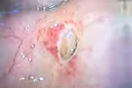 Đau bụng, buồn nôn, đi khám phát hiện thủng tạng rỗng do viêm loét dạ dày