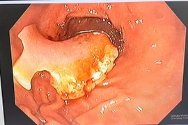 Người phụ nữ vô tình nuốt nguyên hàm răng giả khi uống thuốc