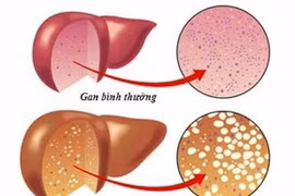 Top 9 thực phẩm giúp đẩy lùi bệnh gan nhiễm mỡ 