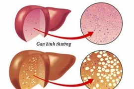 Top 9 thực phẩm giúp đẩy lùi bệnh gan nhiễm mỡ 