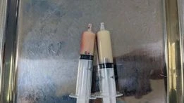 Huyết tương đục như sữa vì... nghiện rượu