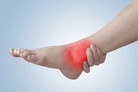 Sưng phù mắt cá chân dấu hiệu cảnh báo sức khỏe đang gặp vấn đề