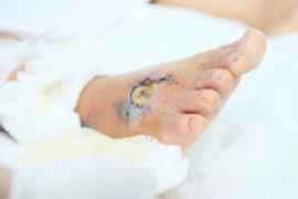 Hoại tử chân, suy đa tạng do... chữa rắn cắn tại nhà thầy lang