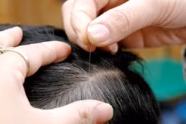 Trẻ em bị tóc bạc sớm có phải là dấu hiệu cảnh báo của bệnh lý?