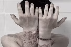 "Tiền mất tật mang" vì tự mua thuốc trên mạng bôi chữa ngứa 