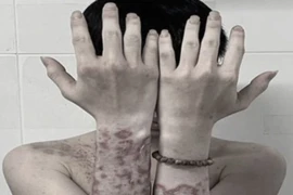 "Tiền mất tật mang" vì tự mua thuốc trên mạng bôi chữa ngứa 