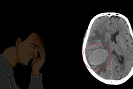 Thấy yếu nửa người, đi khám… bất ngờ phát hiện ung thư phổi giai đoạn cuối