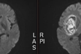 Xuất huyết não vì tự ý bỏ thuốc huyết áp