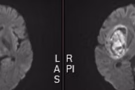 Xuất huyết não vì tự ý bỏ thuốc huyết áp